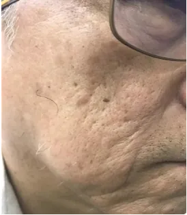 3 months after treatment